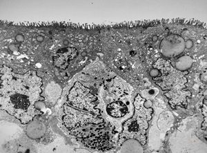 celiakia celiakia